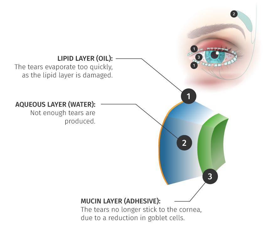 Dry Eye - Diagnose Or Treat Your Dry Eye