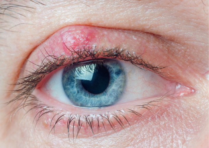 Chalazions Styes Blepharitis Everything You Need To Know About Eyelid Diseases 